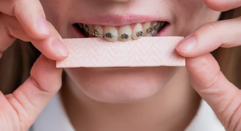 Qué alimentos evitar si llevas brackets: chicle