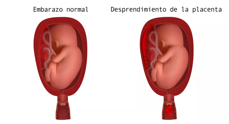 Desprendimiento de la placenta y causas