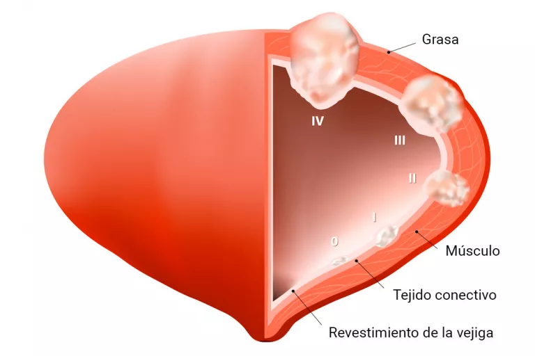 Fases del cáncer de vejiga