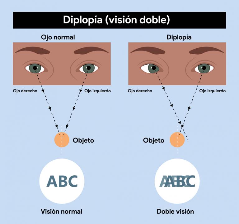 Infografía: qué es la diplopía o visión doble