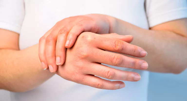 Influencia del estrés en el fenómeno de Raynaud