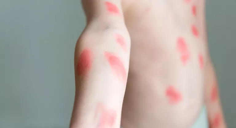 Boy with red blisters all over his body