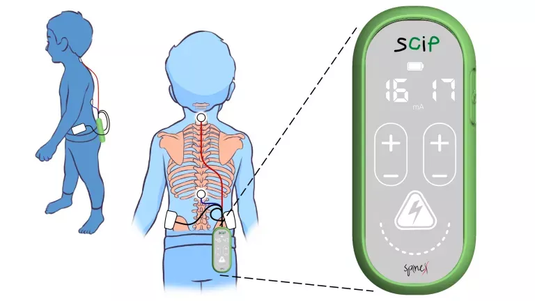 Terapia experimental para volver a andar niños con parálisis cerebral