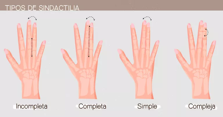 Ilustración tipos de sindactilia 