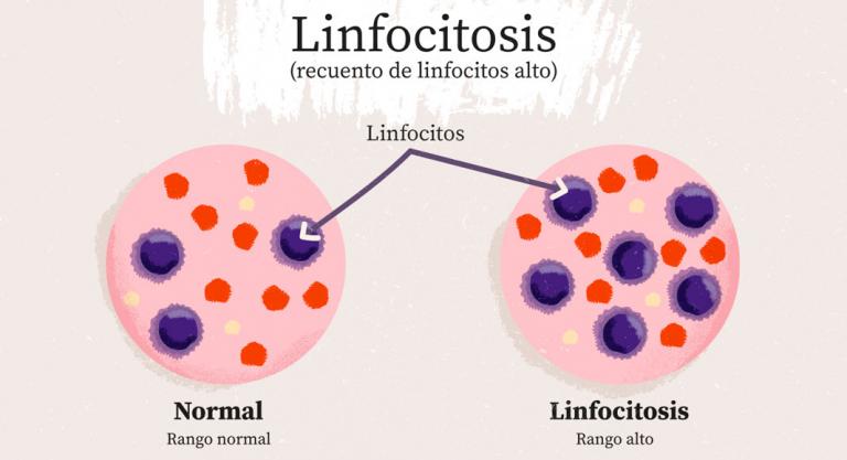 Ilustración: aumento de los niveles de linfocitos en la sangre
