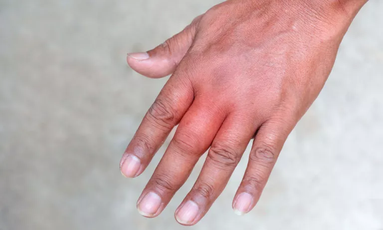 Hand with swollen fingers