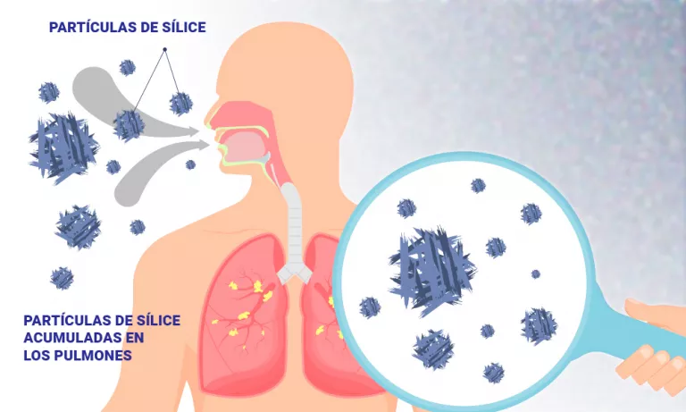 Ilustración de cómo se produce la silicosis