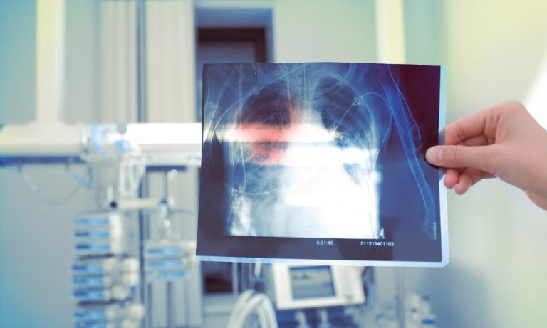 Médico mostrando una radiografía de un pulmón con silicosis