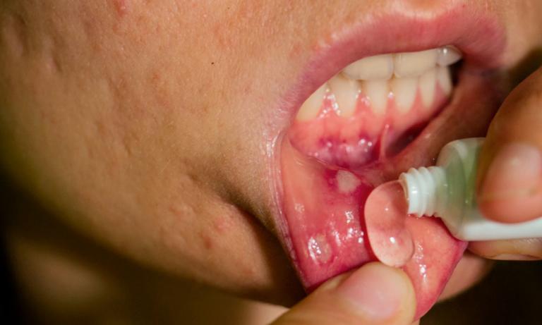 Persona aplicando pomada para tratar un afta bucal que tiene en su boca
