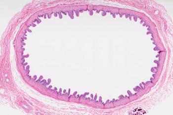 Incontinencia urinaria por anomalías del tracto genital