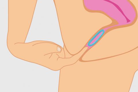 Cómo se usa el anillo vaginal