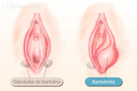Causas de la bartolinitis