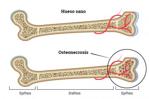 Causa de osteonecrosis
