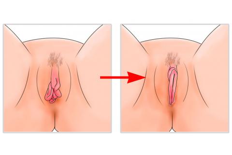 Clitoriplastia