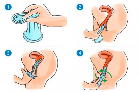 Cómo se pone el condón femenino (ilustración)