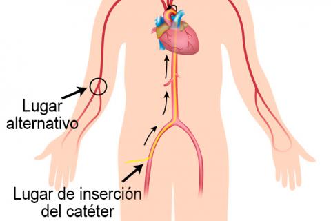 Cómo se hace el cateterismo