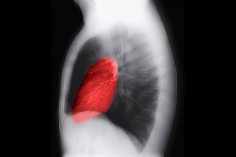 Radiografía de tórax muestra complicaciones por colesterol alto
