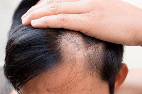 Hombre con pérdida de cabello en una zona de la cabeza