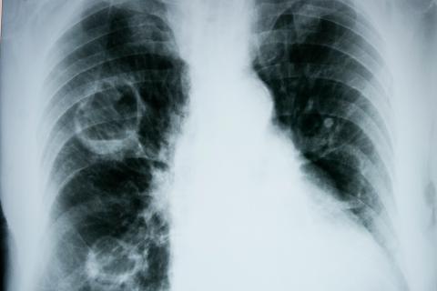 Diagnóstico del edema pulmonar