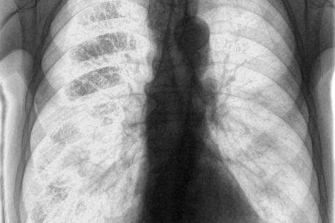 Diagnóstico de la tuberculosis por radiografía de tórax