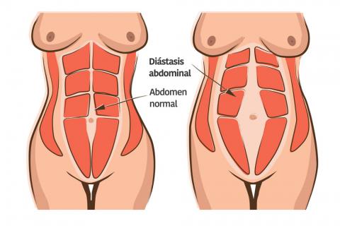 Cómo identificar si tenemos diástasis abdominal