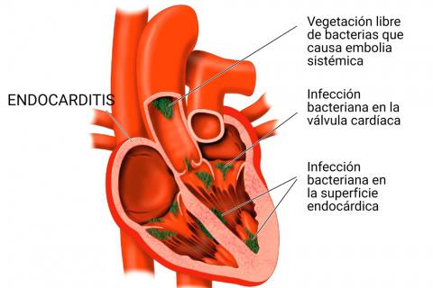Ilustración endocarditis