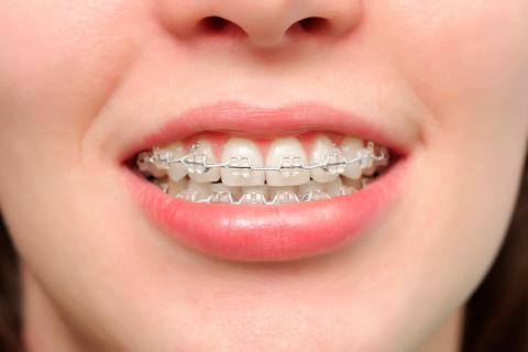 ¿Cuándo se necesita ortodoncia?