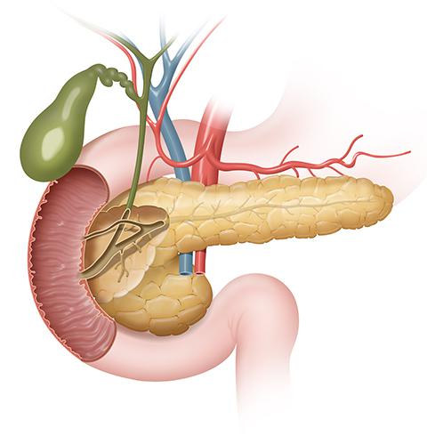 Qué son los tumores exocrinos de páncreas