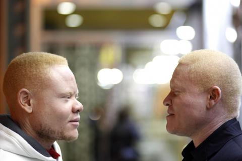 Dos personas con síntomas del albinismo