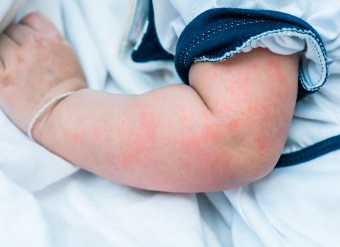 Resultado de imagen de niños alérgicos