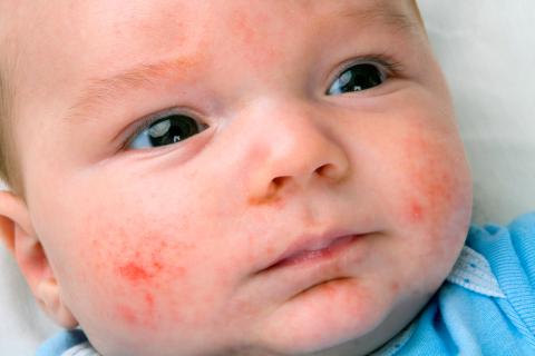 Síntomas de la alergia a las proteínas de leche de vaca en un bebé