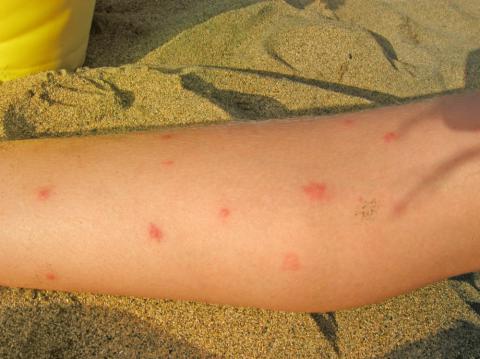 Síntomas del dengue en la piel