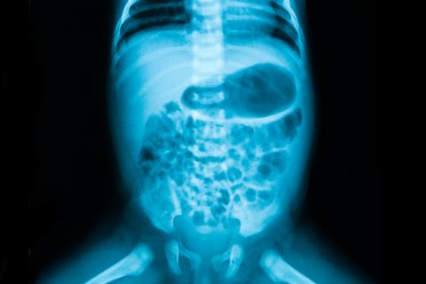 Radiografía de abdomen de un bebé