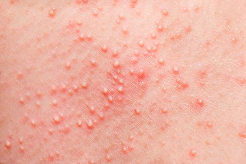Reacción alérgica en la piel a un medicamento