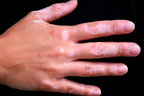 Síntomas de vitíligo en la mano