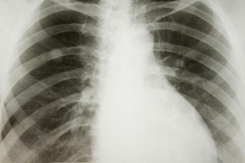 Rayos X del pulmón