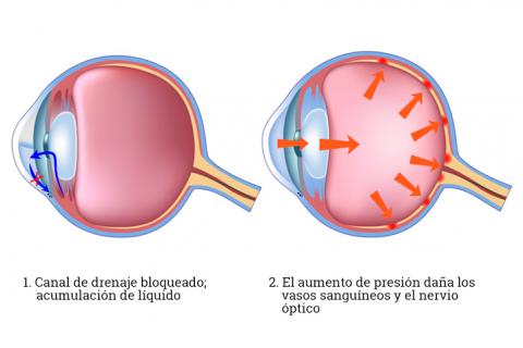 Tipos de glaucoma y a qué se debe
