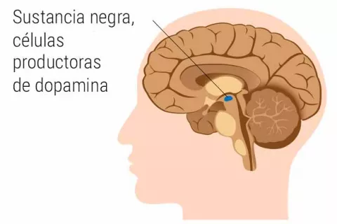 Ilustración de un tipo de párkinson
