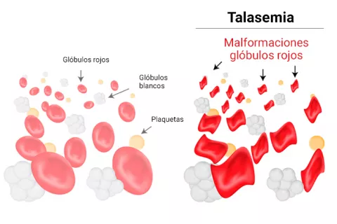 Gráfico de la talasemia