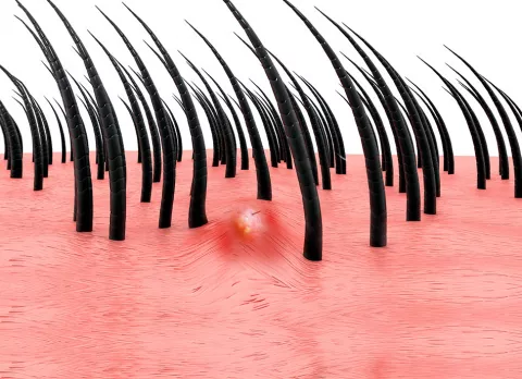 Foliculitis o pelos encarnados