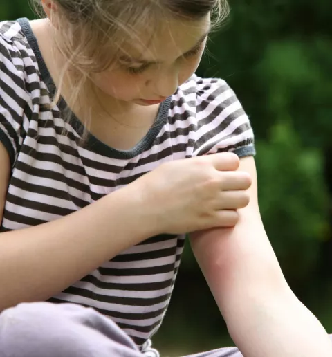 Niña pequeña con alergias cutáneas