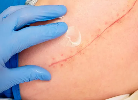 Recomendaciones para cuidar la cicatriz de la cesárea Cuidado de una cicatriz de la cesárea