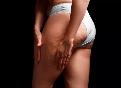 Síntomas de una mujer con lipedema