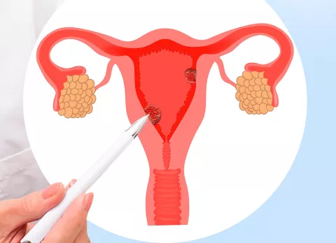 ¿Qué son los pólipos uterinos? Mujer con un pólipo en el útero