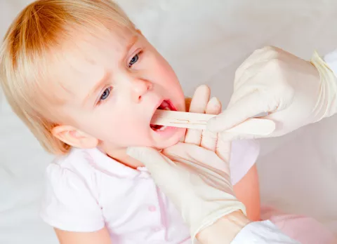 Síntomas del niño con síndrome de Marshall Niño con fiebre y amigdalitis por síndrome de Marshall