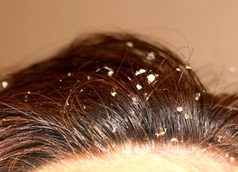 Descamación del cuero cabelludo
