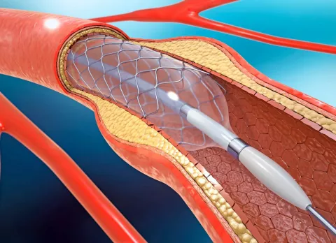 Stent coronario, en qué consiste y cuándo está indicado Stent coronario