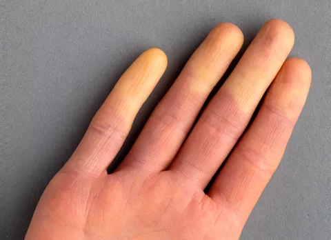 Dedos de la mano blancos por Fenómeno de Raynaud Fenómeno de Raynaud en la mano