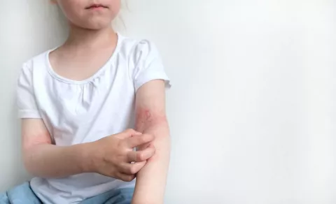 Niña se rasca las erupciones en el brazo por dermatitis atópica