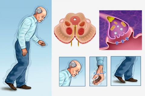 Ilustración de un anciano con síntomas de parkinson